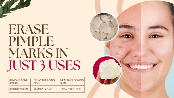 Erase Pimple Marks in Just 3 Uses