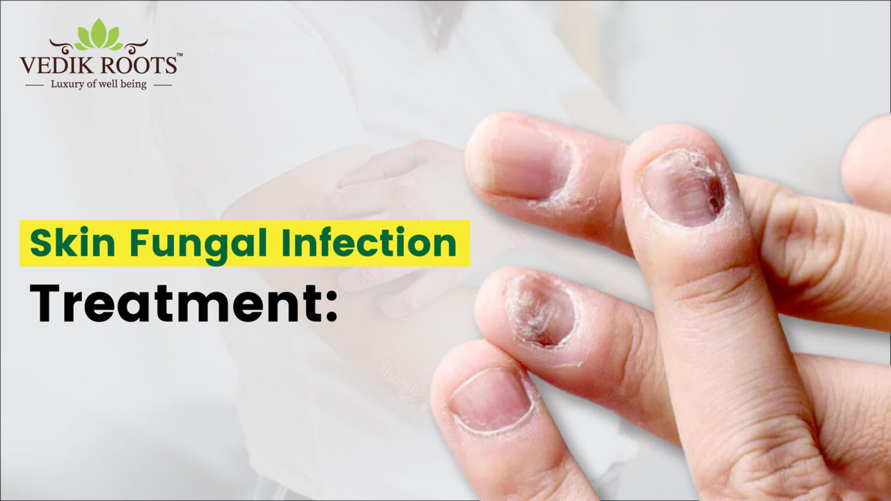 Natural Remedies for Fungal Skin Infections – Vedikroots