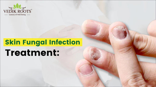 5 Natural Remedies to prevent From Skin Fungal Infections