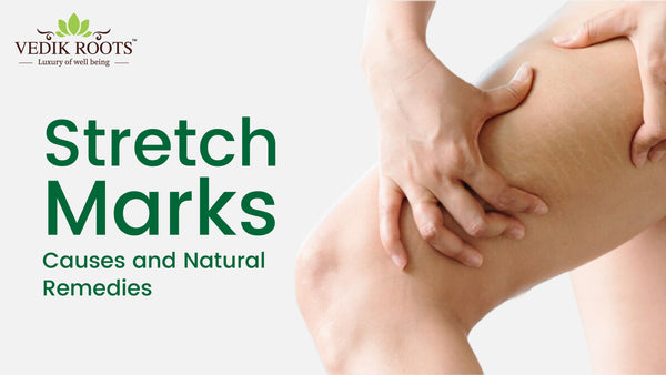 Stretch Marks - Causes and Natural Remedies